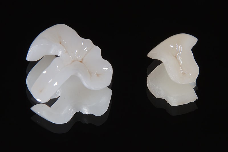 オールセラミック