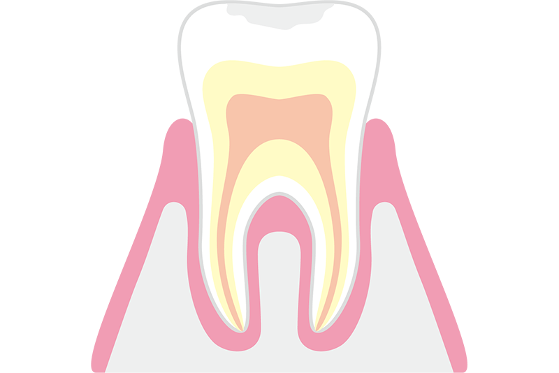 超初期むし歯（CO）