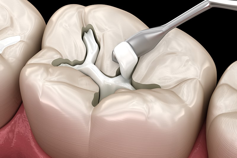 レジンの詰め物